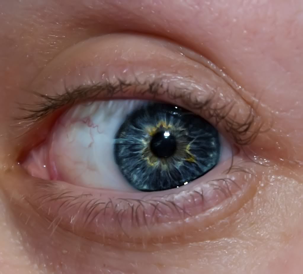 Freckle On Eyeball