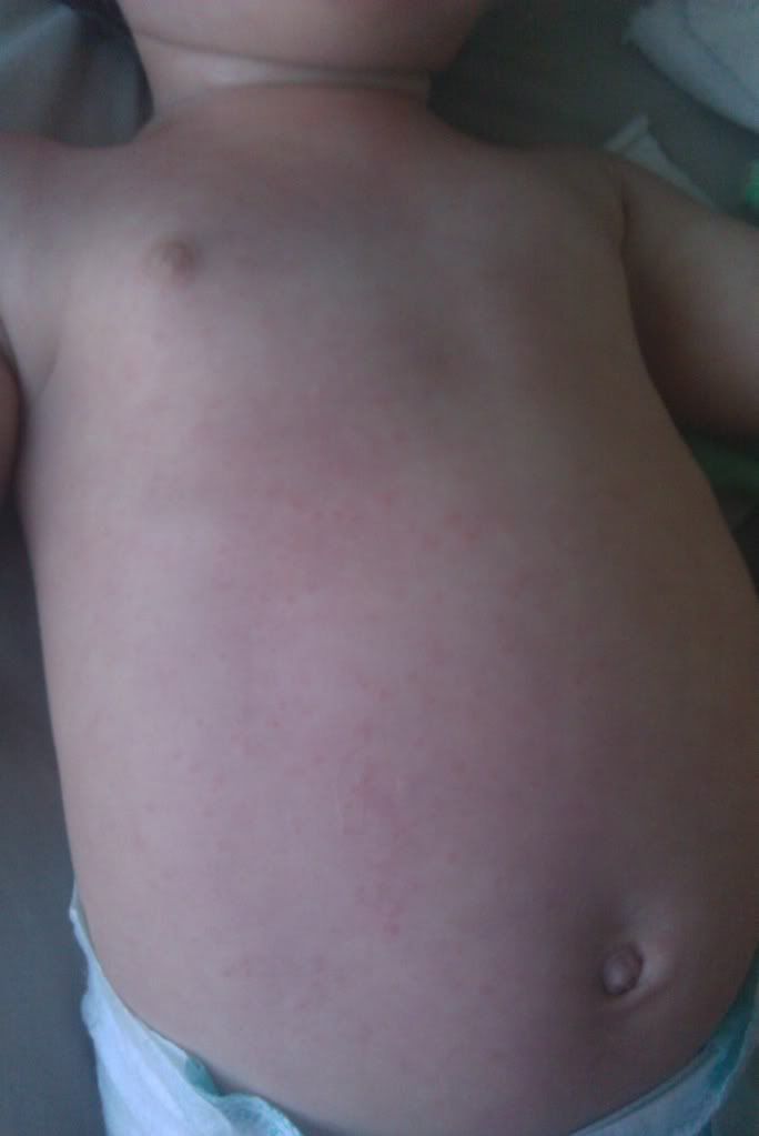 heat rash pictures in toddlers. heat rashes in children.